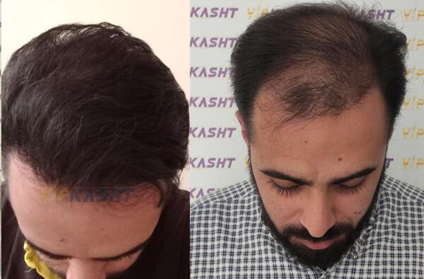 عکس کاشت مو با تراکم بالا