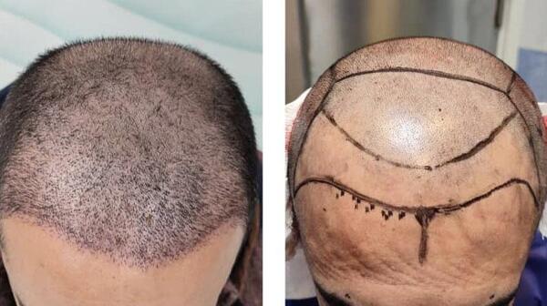 عکس کاشت مو با تراکم بالا