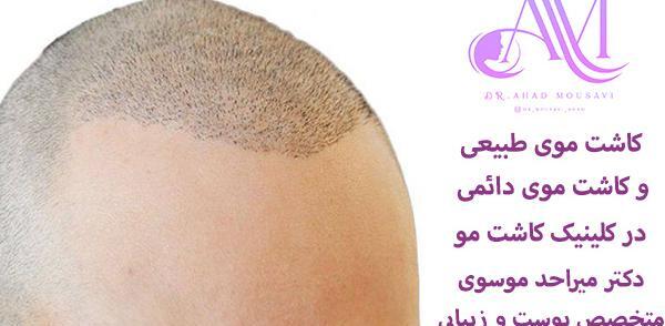 عکس کاشت مو با تراکم بالا