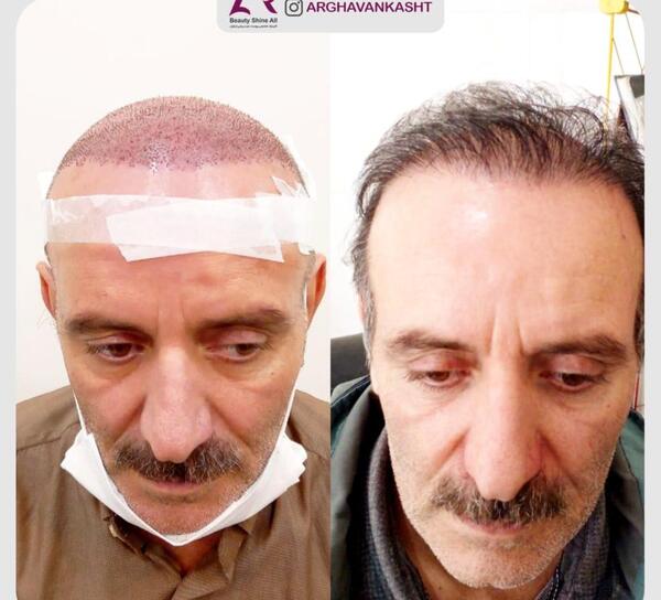 عکس کاشت مو با تراکم بالا