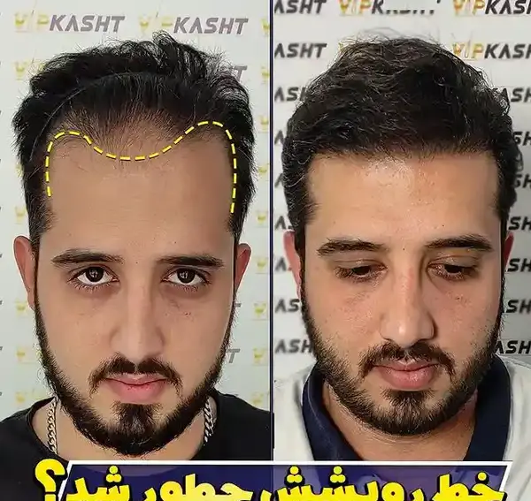 عکس کاشت مو با تراکم بالا