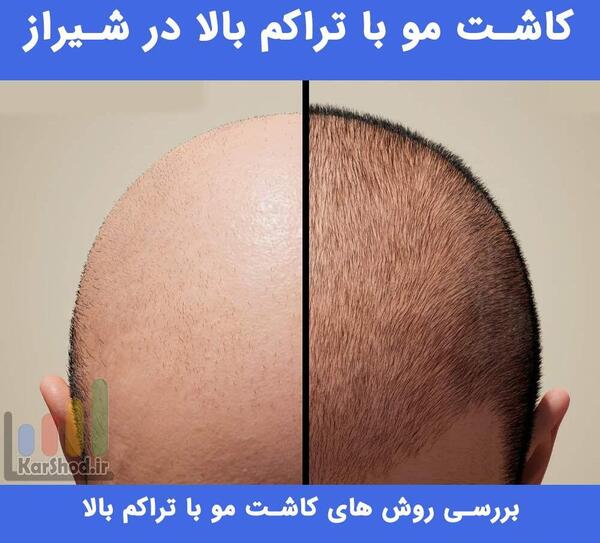 عکس کاشت مو با تراکم بالا