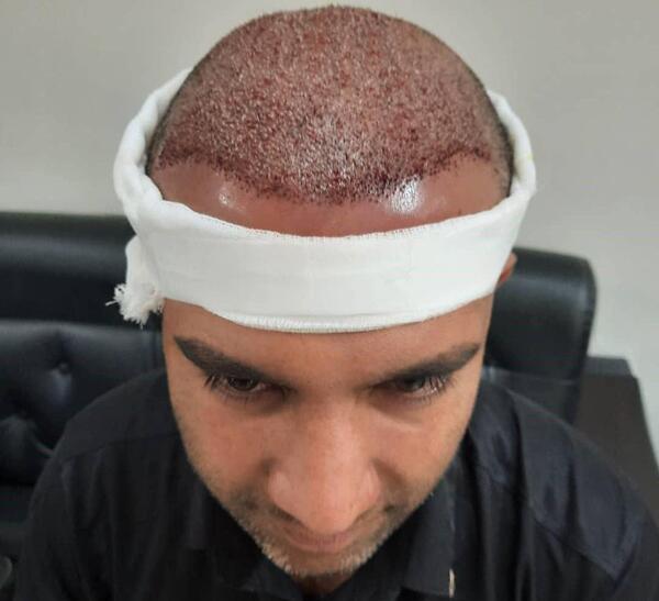 عکس کاشت مو با تراکم بالا