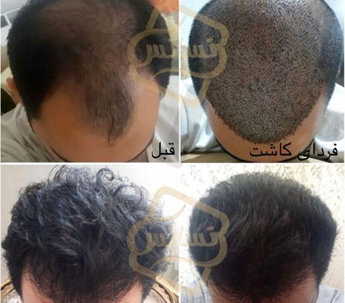 عکس کاشت مو با تراکم بالا