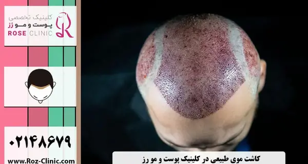 عکس کاشت مو با تراکم بالا