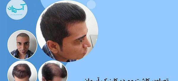 عکس کاشت مو بعد از پنج ماه