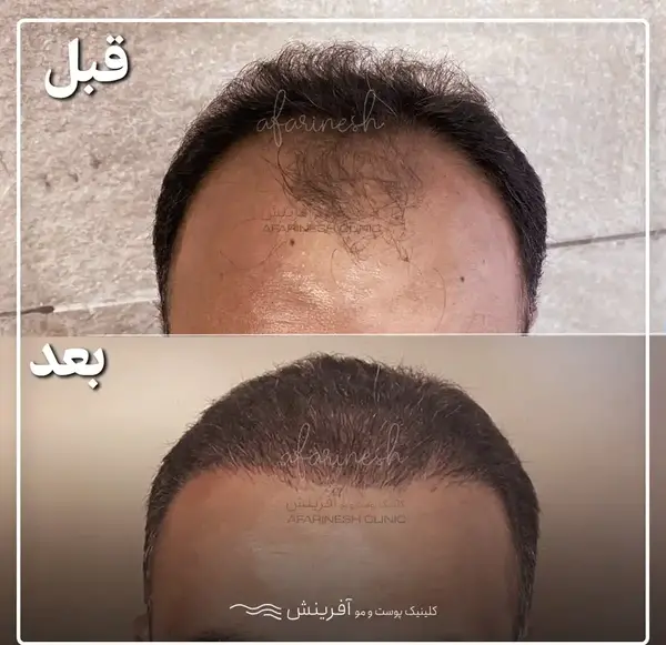 عکس کاشت مو بعد از پنج ماه