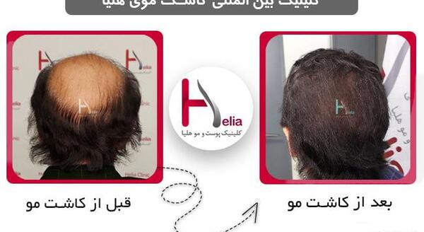 عکس کاشت مو بعد از پنج ماه