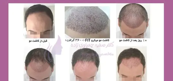 عکس کاشت مو بعد از پنج ماه