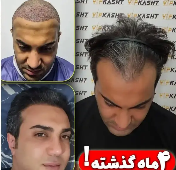 عکس کاشت مو بعد از پنج ماه