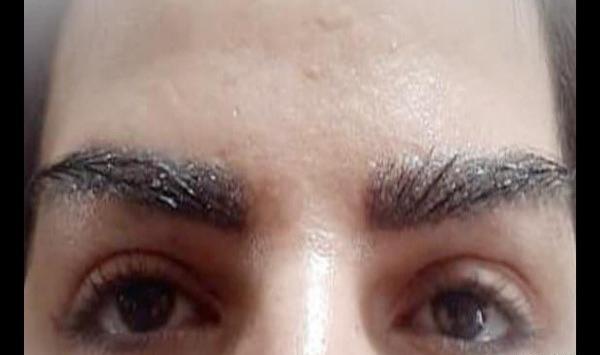 عکس کاشت ابرو بعد از یک ماه