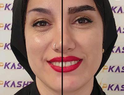 عکس کاشت ابرو بعد از یک ماه
