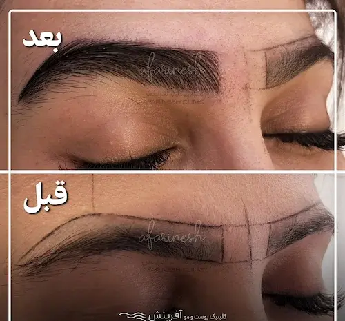 عکس کاشت ابرو بعد از یک ماه