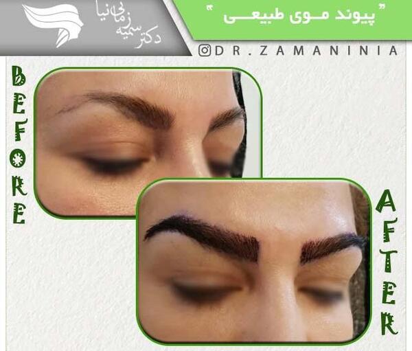 عکس کاشت ابرو بعد از دو ماه