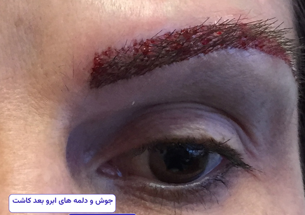 عکس کاشت ابرو بعد از دو ماه
