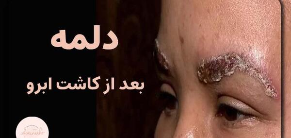 عکس کاشت ابرو بعد از دو ماه