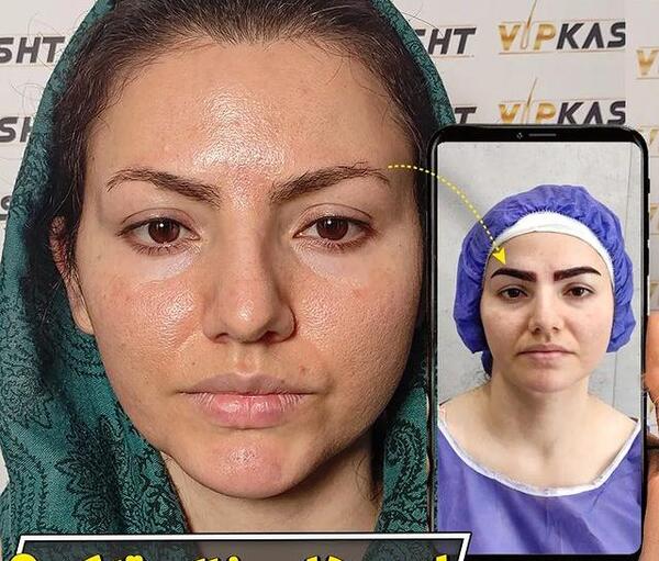 عکس کاشت ابرو بعد از دو ماه