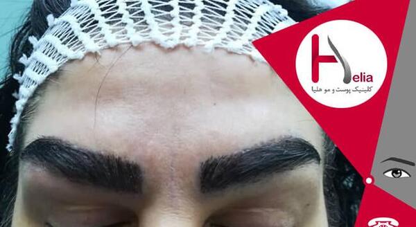 عکس کاشت ابرو بعد از دو ماه