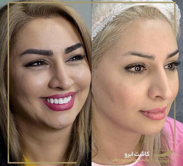 عکس کاشت ابرو دخترانه