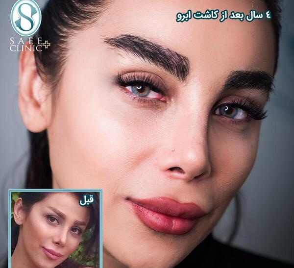 عکس کاشت ابرو دخترانه