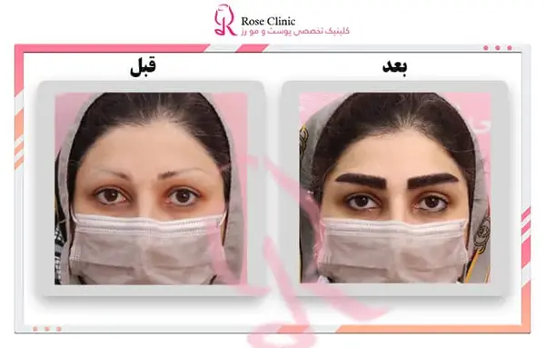 عکس کاشت ابرو دخترانه
