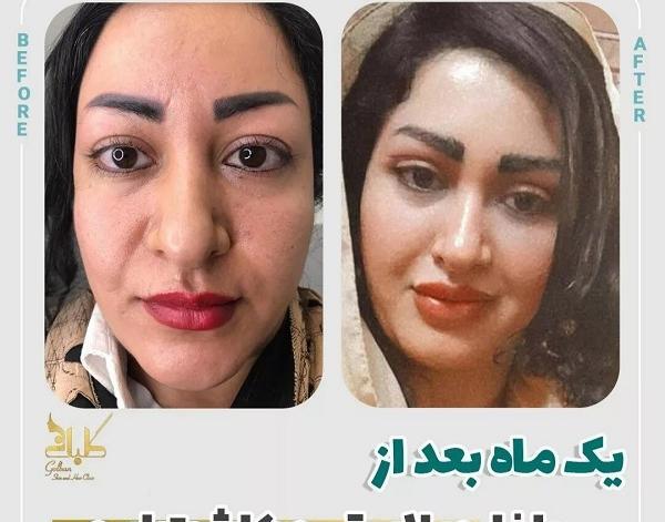 عکس کاشت ابرو با موی طبیعی
