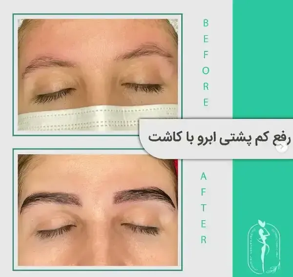 عکس کاشت ابرو با موی طبیعی