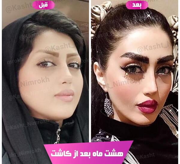 عکس کاشت ابرو با موی طبیعی