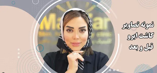 عکس کاشت ابرو با موی طبیعی