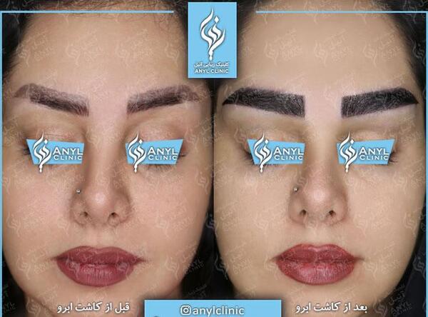 عکس کاشت ابرو با موی طبیعی