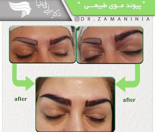 عکس کاشت ابرو با موی طبیعی