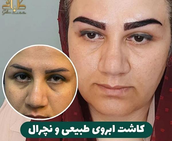 عکس کاشت ابرو با موی طبیعی