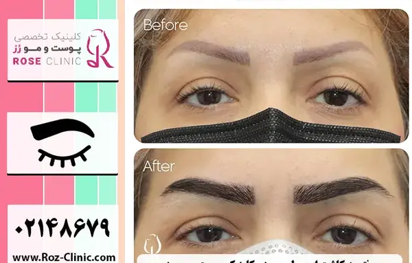 عکس کاشت ابرو با موی طبیعی
