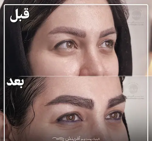 عکس کاشت ابرو با موی طبیعی