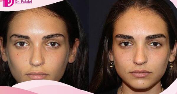 عکس کاشت ابرو با موی طبیعی