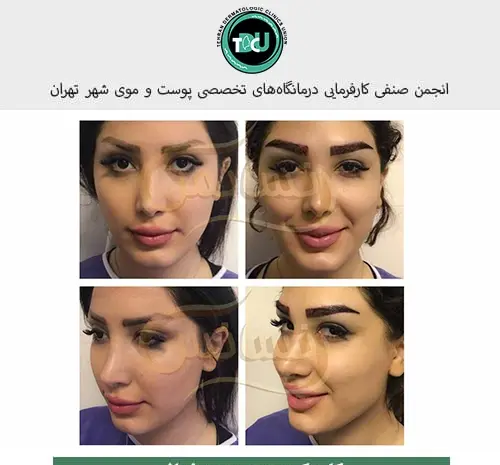 عکس کاشت ابرو با موی طبیعی