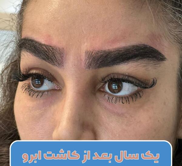 عکس کاشت ابرو با موی طبیعی