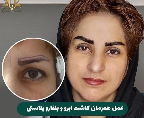 عکس کاشت ابرو با موی طبیعی