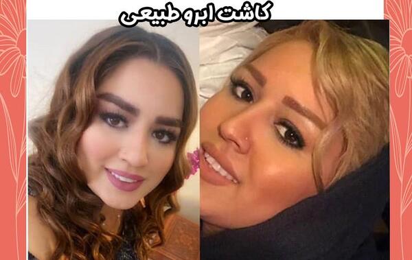 عکس کاشت ابرو با موی طبیعی