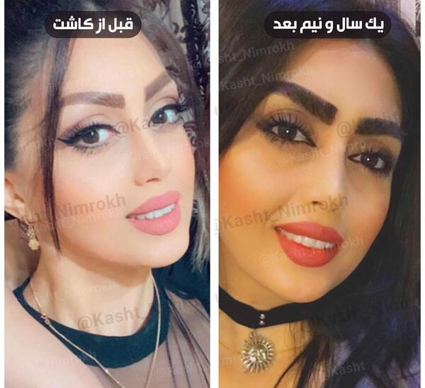 عکس کاشت ابرو با موی طبیعی