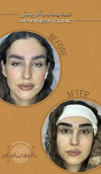 عکس کاشت ابرو با موی طبیعی