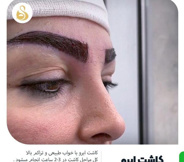 عکس کاشت ابرو با موی طبیعی