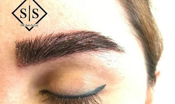 عکس های کاشت ابرو طبیعی
