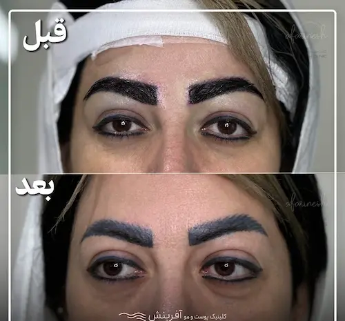 عکس های کاشت ابرو طبیعی