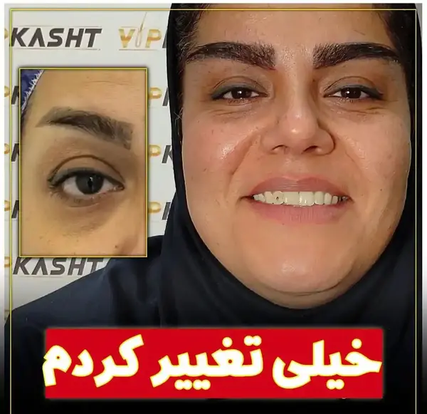 عکس های کاشت ابرو طبیعی