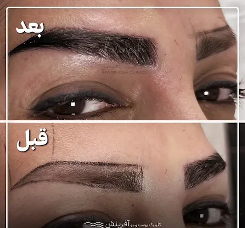 عکس های کاشت ابرو طبیعی
