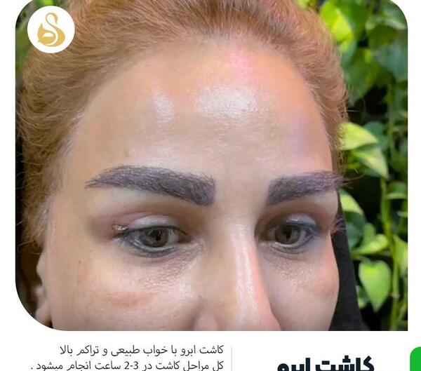 عکس های کاشت ابرو طبیعی