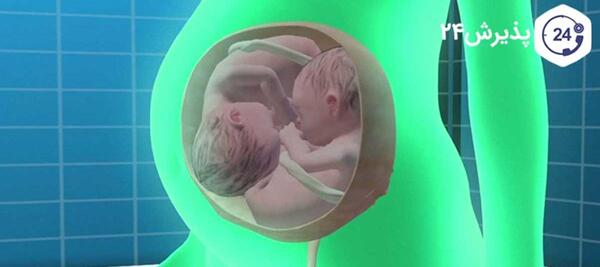 ivf دوقلو عکس بچه های ای وی اف