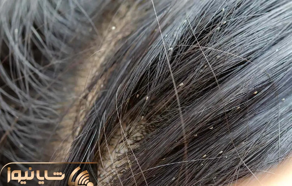 عکس بچه های شپش