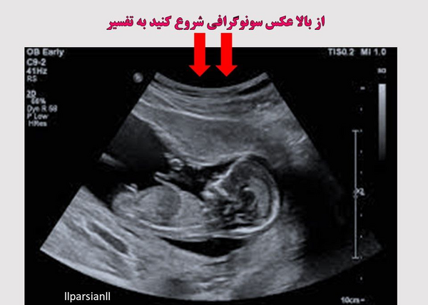 عکس سونو بچه سه ماهه